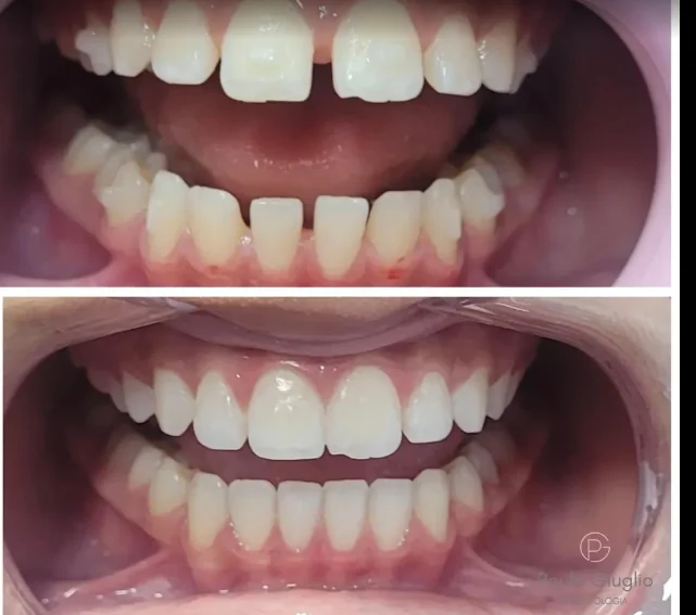 Registro odontológico de alinhamento dentário em duas imagens