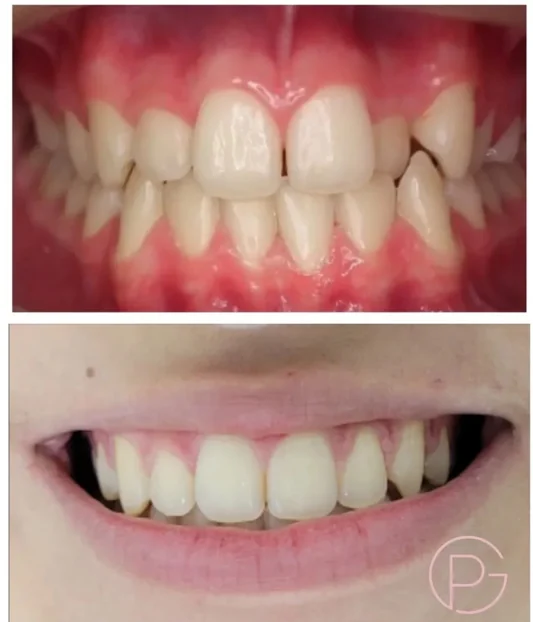 Duas fotografias do sorriso em etapas distintas do tratamento